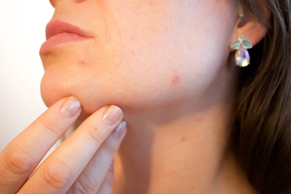 Saiba como cuidar e prevenir o aparecimento de acne