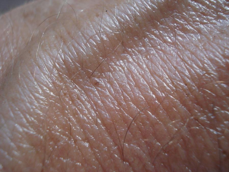 Câncer de pele: como diferenciar uma pinta de uma lesão mais grave? 