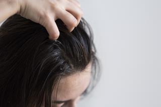 close-up-woman-with-dandruff-issues